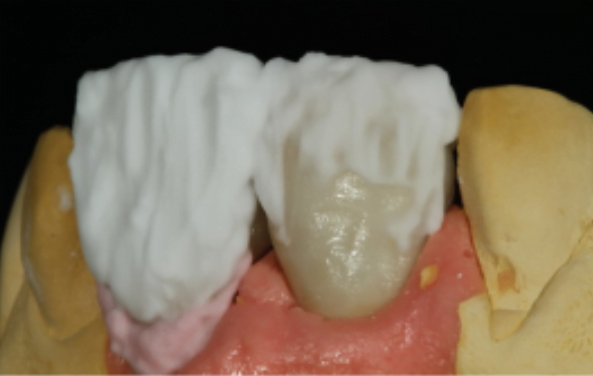 Digital dentistry - benefits of cad/cam systems digital dentistry benefits of cad cam systems 6