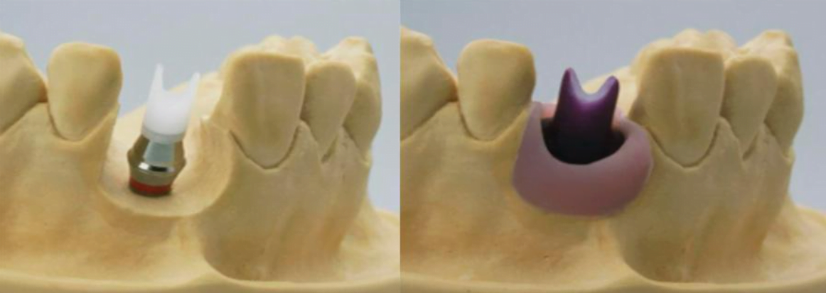 Clinical cases in which it is recommended to install individual abutments