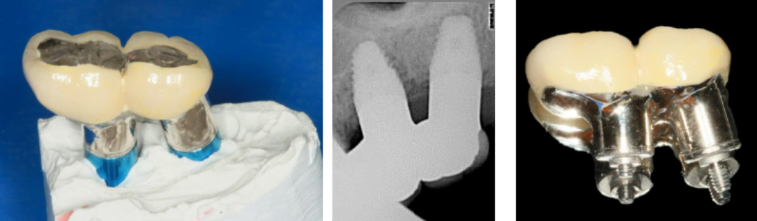 Cast screw-retained abutments compensate for uneven dental implant placement, enabling group restorations.
