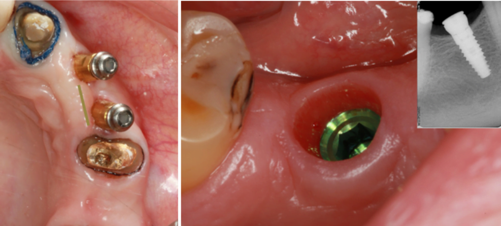 Dental implants installed with vertical deviation from the occlusal plane