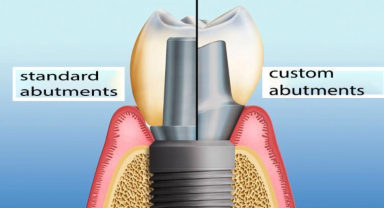 Individual And Standard Abutments - Features And Benefits