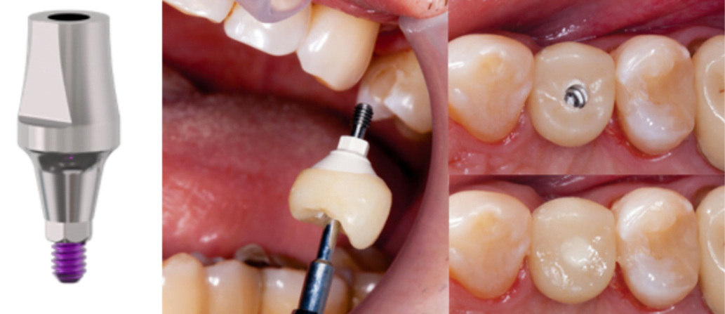 A t-base screw-retained abutment designed for single restorations with the crown formed directly on top without a separate sleeve.