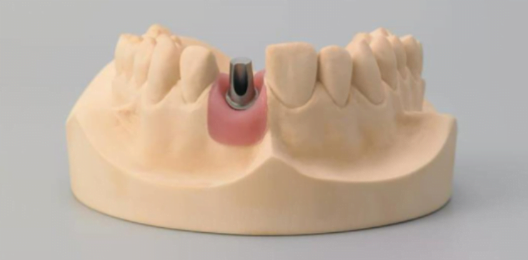 Standard angled abutment versus cast custom abutment on a model demonstrating different manufacturing processes.