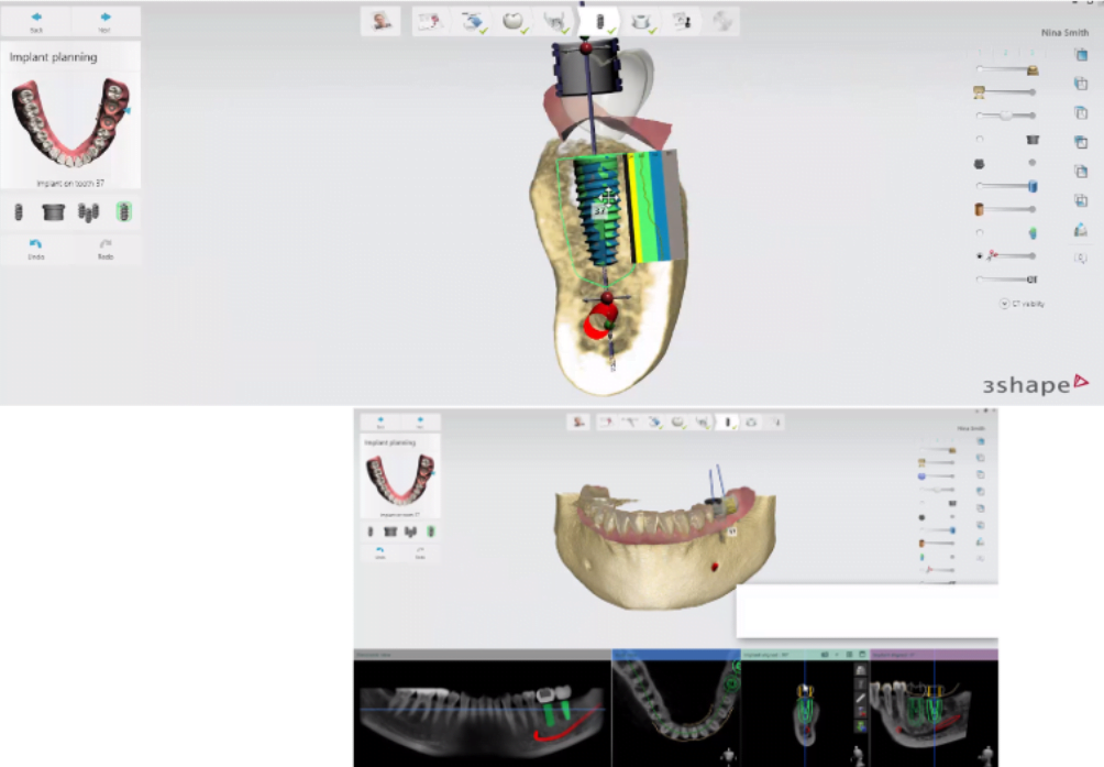 Digital model of the implant location on which the surgical template will be made