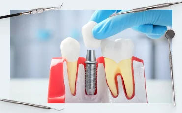Individual and standard abutments – features and benefits