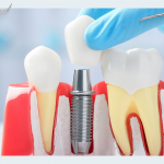 Individual and standard abutments – features and benefits