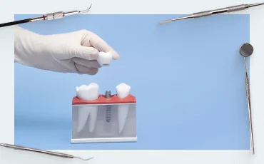 History of implantology: Part I