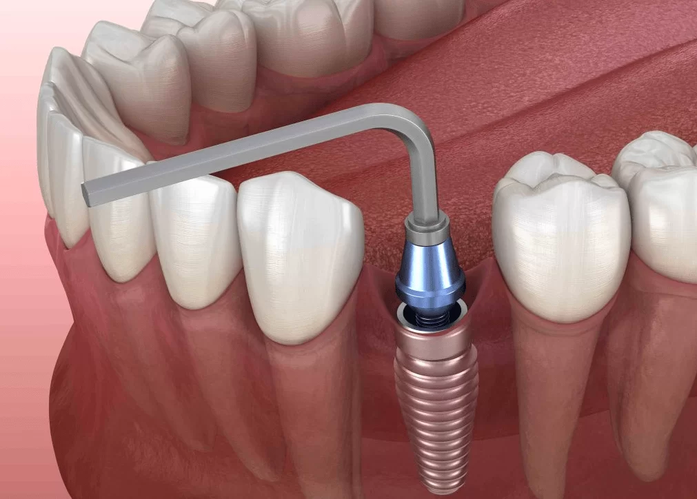 Fixation of the titanium abutment in the implant