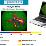 Now caries can be found earlier, the new technology is the optical scanner “Spectra”