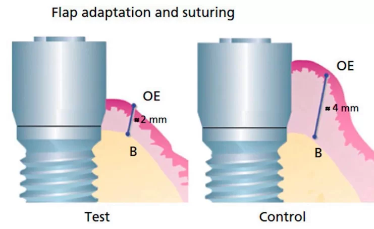 Soft tissue implant integration (part 3) soft tissue implant integration 3