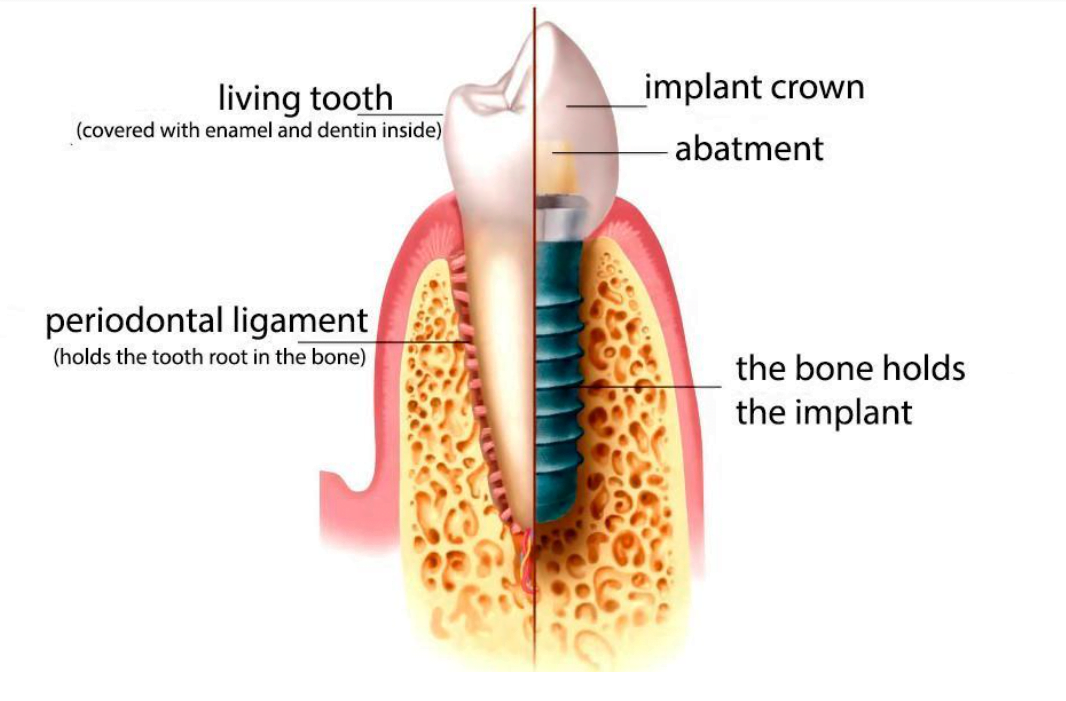 What is better, a tooth or an implant? Part 1 what is better a tooth or an implant 3