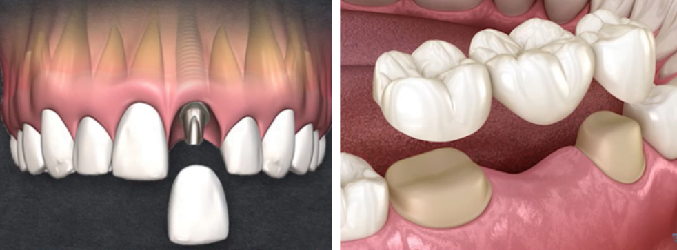 What is better, a tooth or an implant? Part 2 a tooth or an implant 8