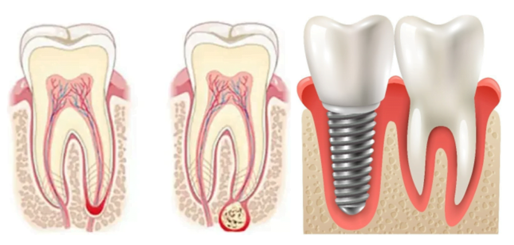 A tooth or an implant