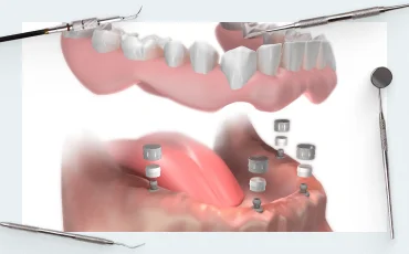 How to choose the right multi-unit abutments