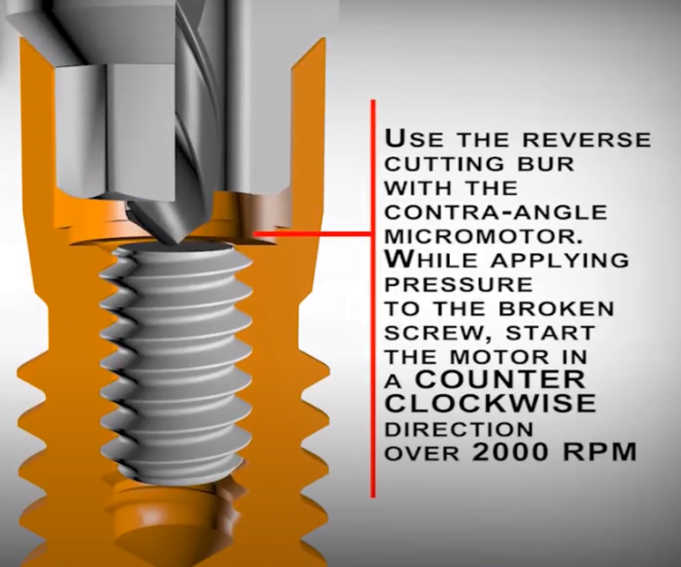 How To Remove A Broken Screw From A Dental Implant A Practical Guide