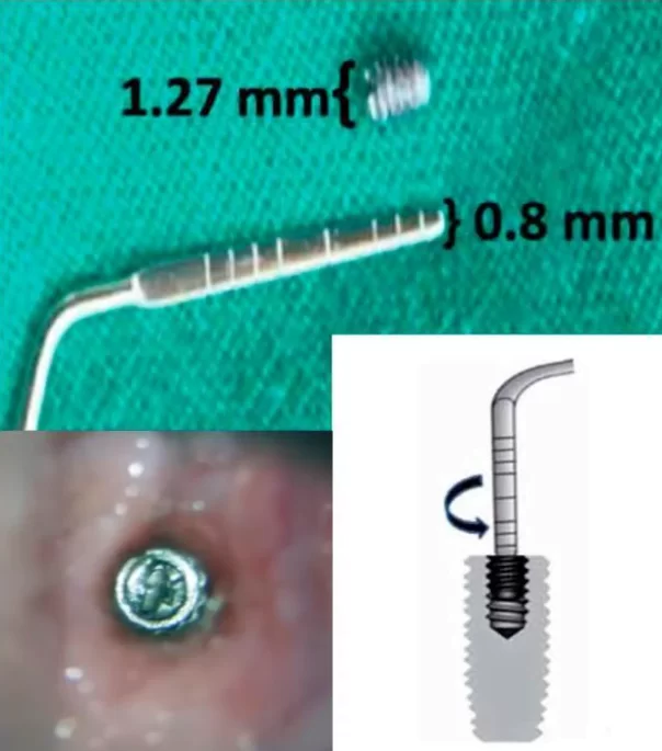 Example of implant screw extraction