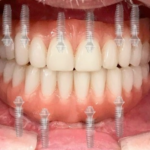 Why dental implants are becoming an increasingly popular option for tooth restoration