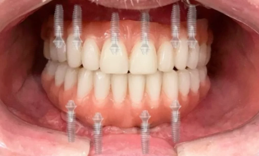 Dental implants, tooth restoration