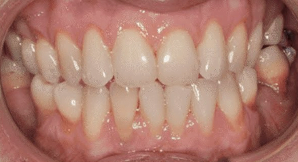 Why Soft Gums Are More Prone To Inflammation New Research Results