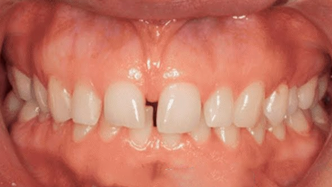 What Are Gums (Gingivae)?