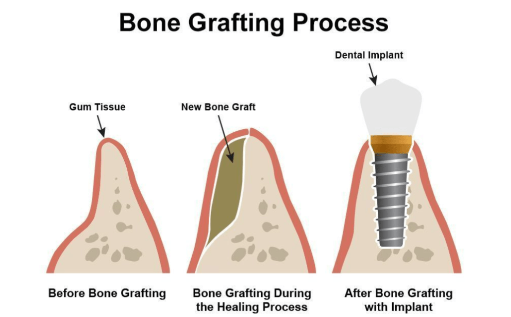 Breakthrough Bone Regeneration: Special Hydrogel Mimics Natural Environment for Recovery