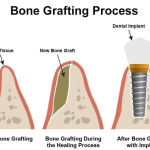 Breakthrough Bone Regeneration: Special Hydrogel Mimics Natural Environment for Recovery