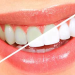 What’s new in cosmetic dentistry, in the areas of teeth whitening and veneers