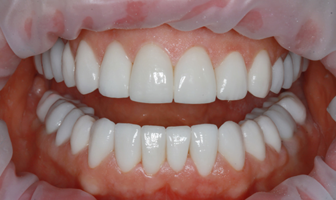 What's new in cosmetic dentistry, in the areas of teeth whitening and veneers implant treatment 3