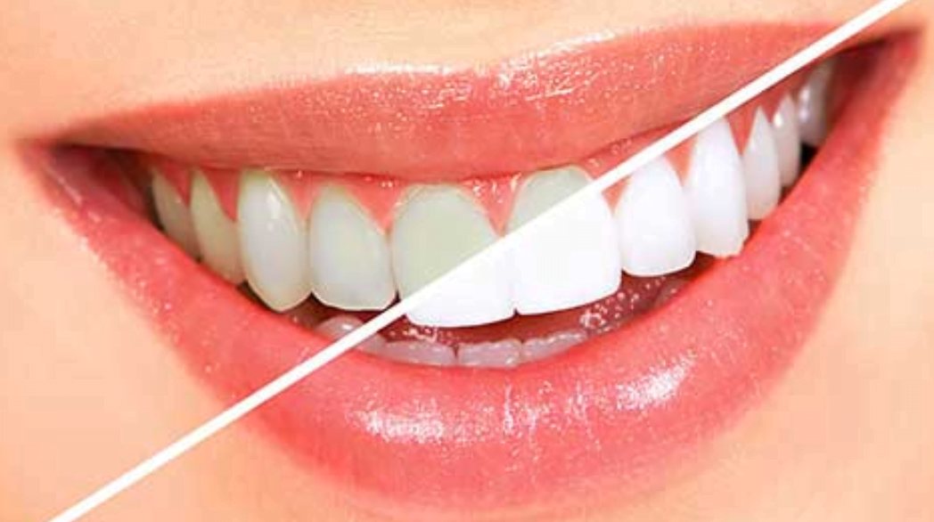 What's new in cosmetic dentistry, in the areas of teeth whitening and veneers implant treatment