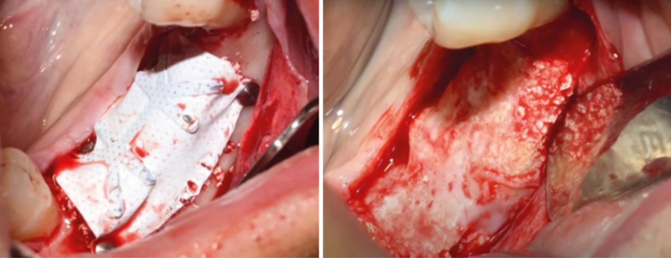Teflon membrane fixation and augmentation result after removal of the barrier membrane