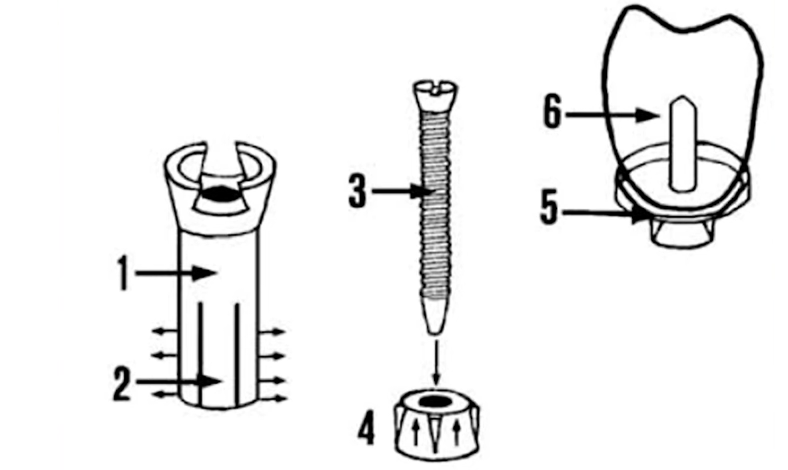 The leger-dorez implant system (1920)