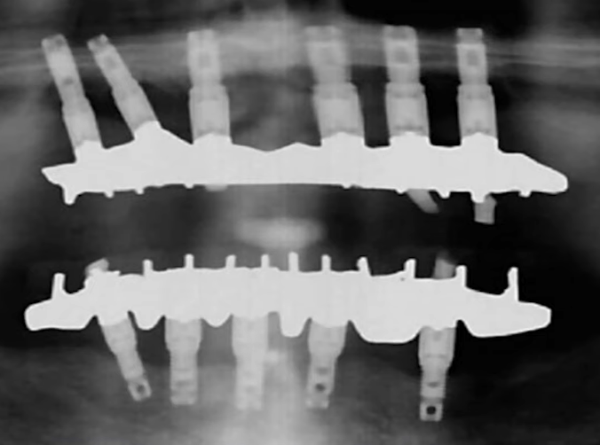 X-ray of sven johansson's dentures, which lasted more than 45 years