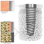 Nanotechnology Revolutionizes Dental Implant Surface Treatment