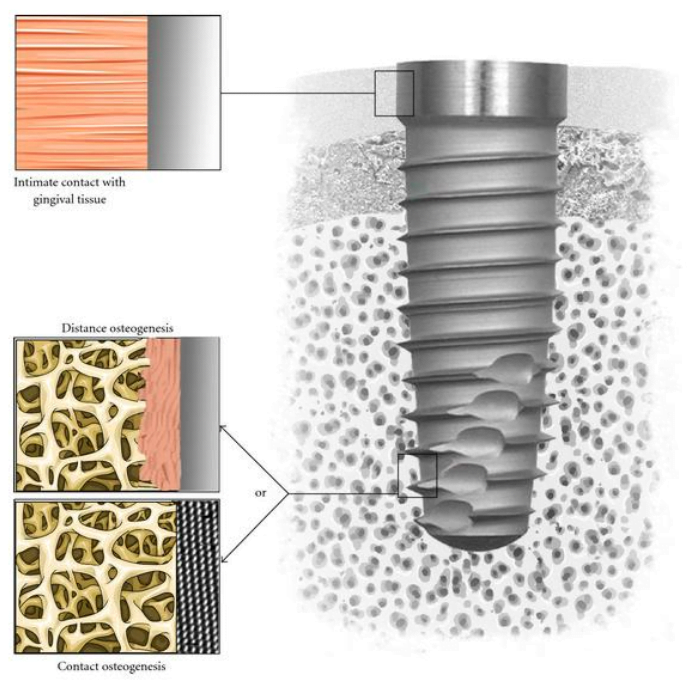 Nanotechnology Revolutionizes Dental Implant Surface Treatment