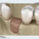 Guided bone regeneration (GBR). Membrane. Part 1