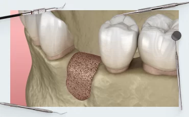 Guided bone regeneration (GBR). Membrane