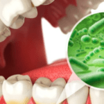 Scientists Discover New Links Between Bacteria Causing Dental Cavities