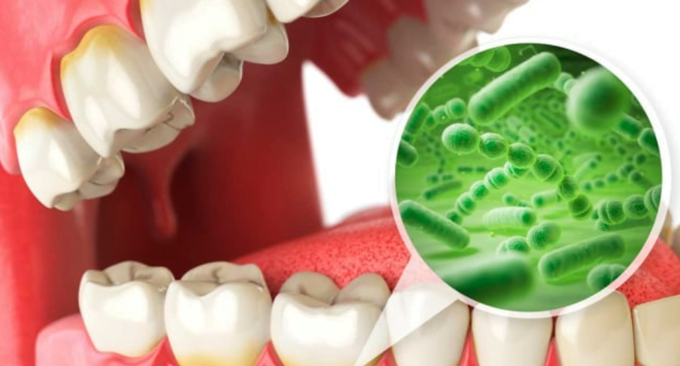 Scientists discover new links between bacteria causing dental cavities