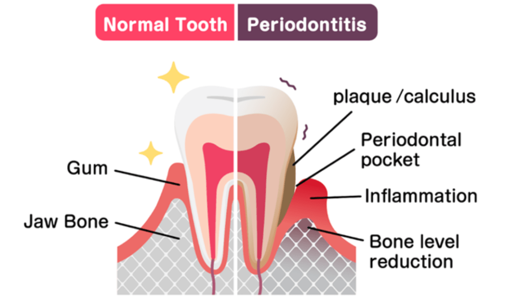 Does the method of irrigation and the use of a 980 nm laser in endodontic treatment affect postoperative pain