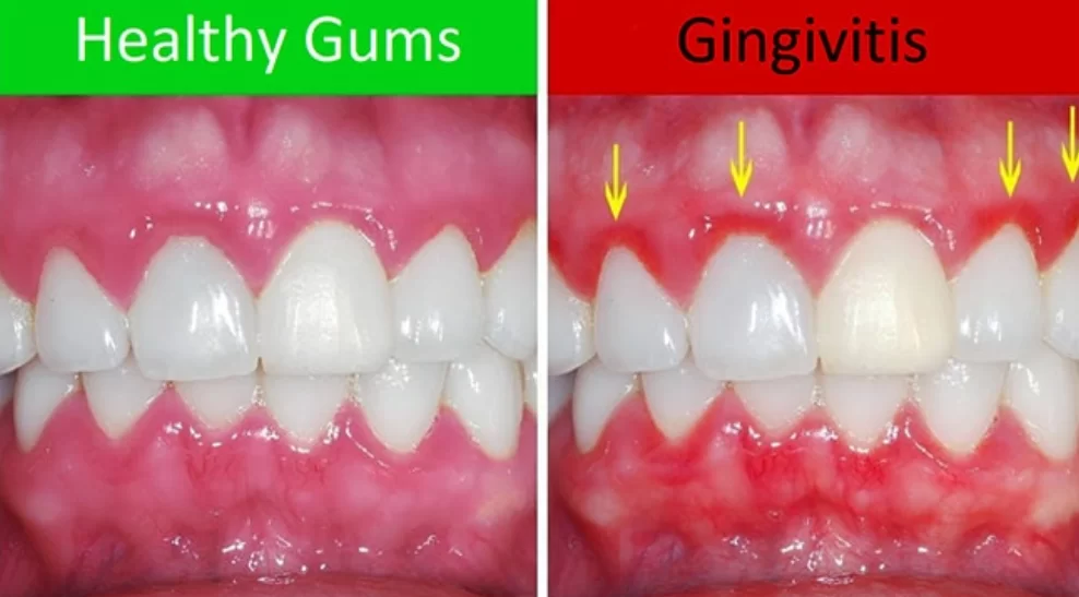 How to diagnose gingivitis - photo