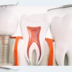Periodontal Treatment vs. Implant Placement: Comparing the Success Prognosis of Both Approaches