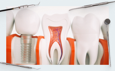 Periodontal Treatment vs. Implant Placement: Comparing the Success Prognosis of Both Approaches