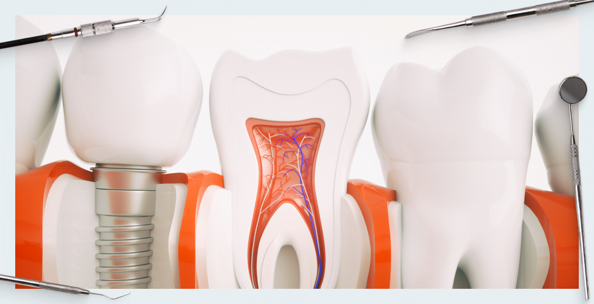 Periodontal Treatment vs. Implant Placement: Comparing the Success Prognosis of Both Approaches