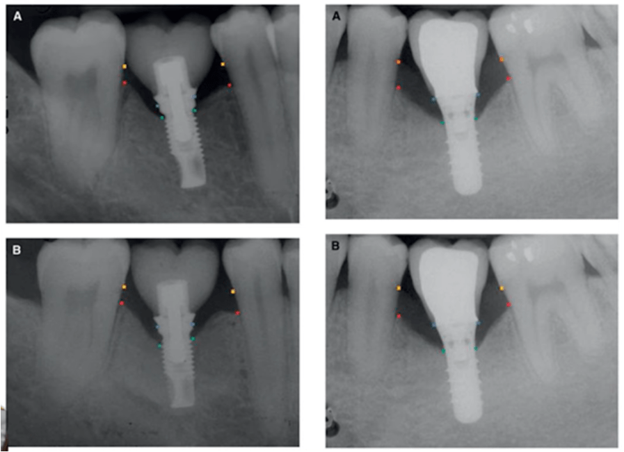 Periodontal treatment vs. Implant placement: comparing the success prognosis of both approaches