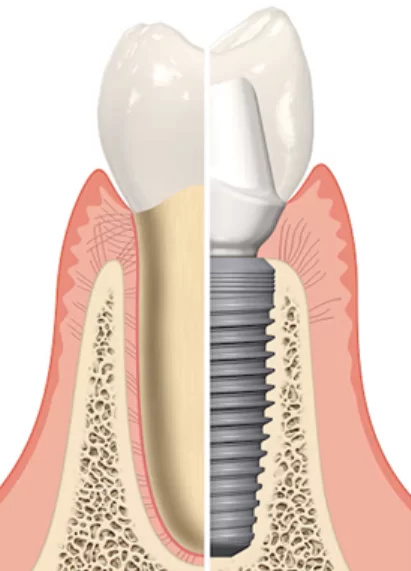Periodontal treatment vs. Implant placement: comparing the success prognosis of both approaches