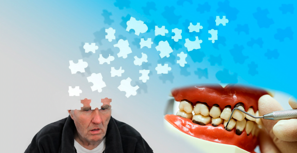 How gum disease can affect the development of alzheimer's disease