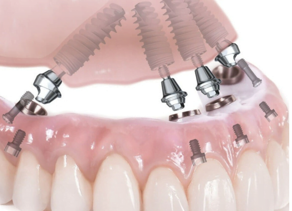 Complete dental restoration with screw fixation and angled abutments