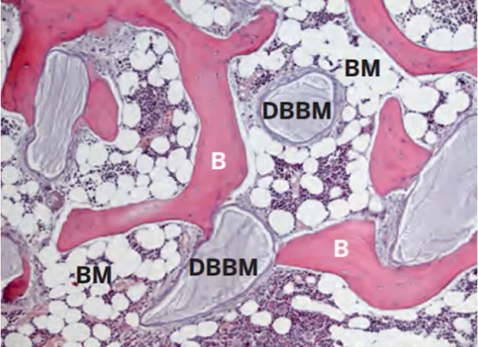Histological section of bone tissue 20 years after sinus elevator, bio-oss was used as a bone graft