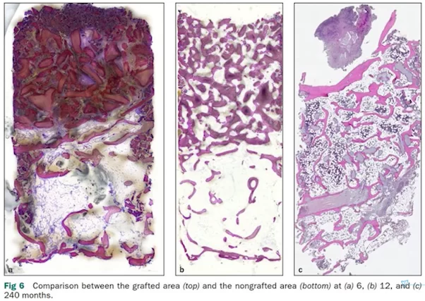 Histological specimens after sinus elevator surgery at 6, 12, and 240 months (20 years) after surgery.