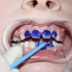 Silver Diamine Fluoride and Dental Sealants: Preventing up to 80% of Cavities in Schoolchildren!